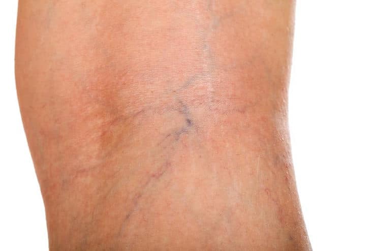 Learn Why Winter is the Best time to Banish Varicose Veins and Spider Veins