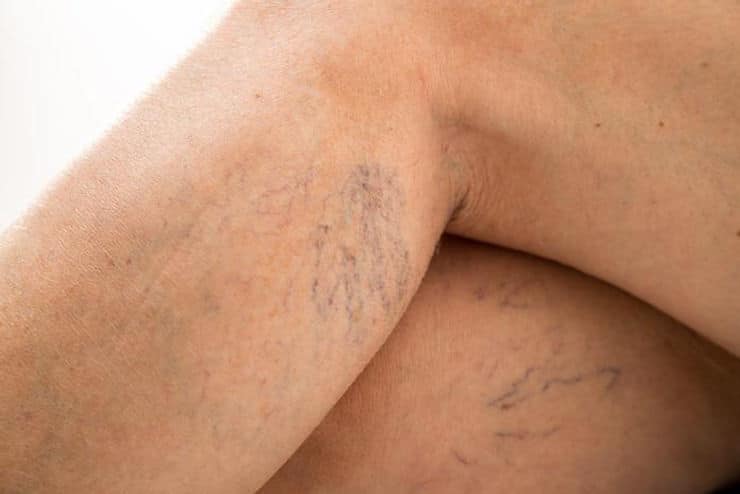 What are the different types of vein treatments?