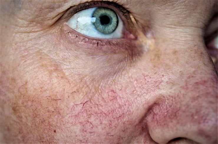 Are Facial Veins Creating a Spidery Web? We Can Help