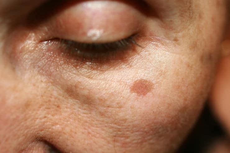 Clear Away Sun-Damaged Skin with CO2 Laser Resurfacing