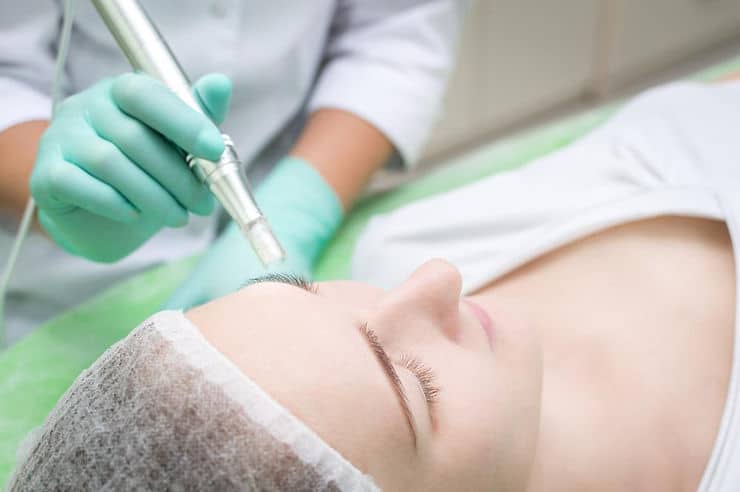 The Many Benefits of RF Microneedling