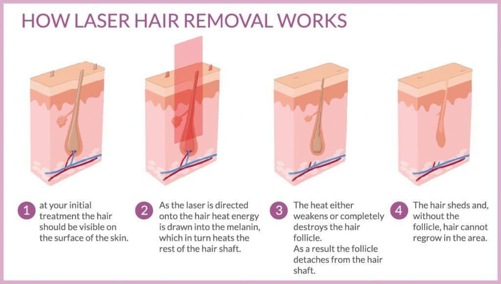 laser hair removal chart.jpg