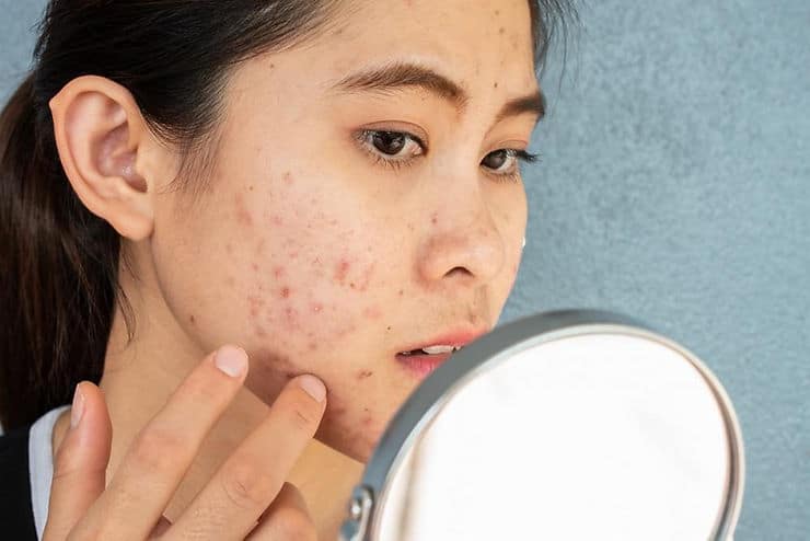 3 Treatments for Pitted, Atrophic Acne Scars