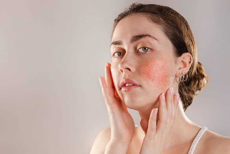 Changing the Condition of Your Rosacea with Facial Treatments