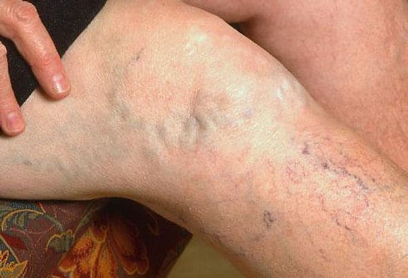 The Link Between Obesity and Varicose Veins