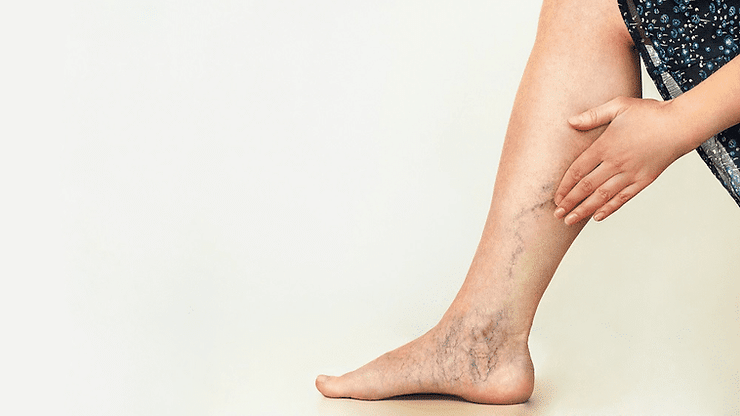 Understanding the Different Types of Vein Treatments