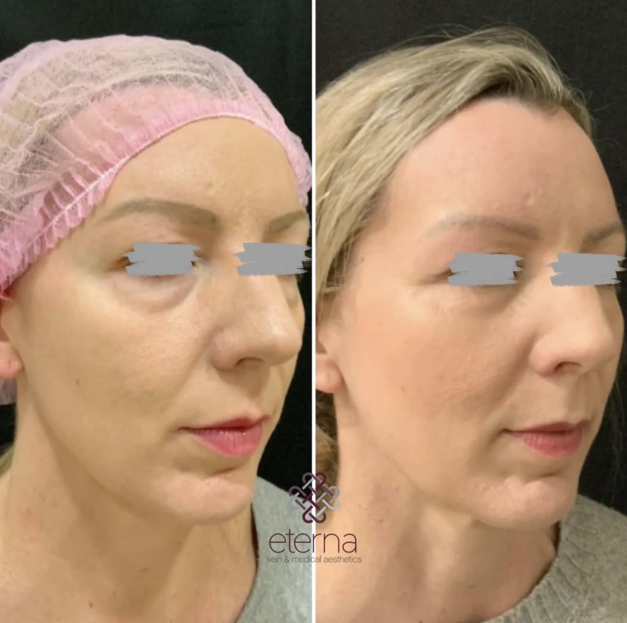 Before and After Image: Agnes RF for Undereye Bags - right-front-oblique