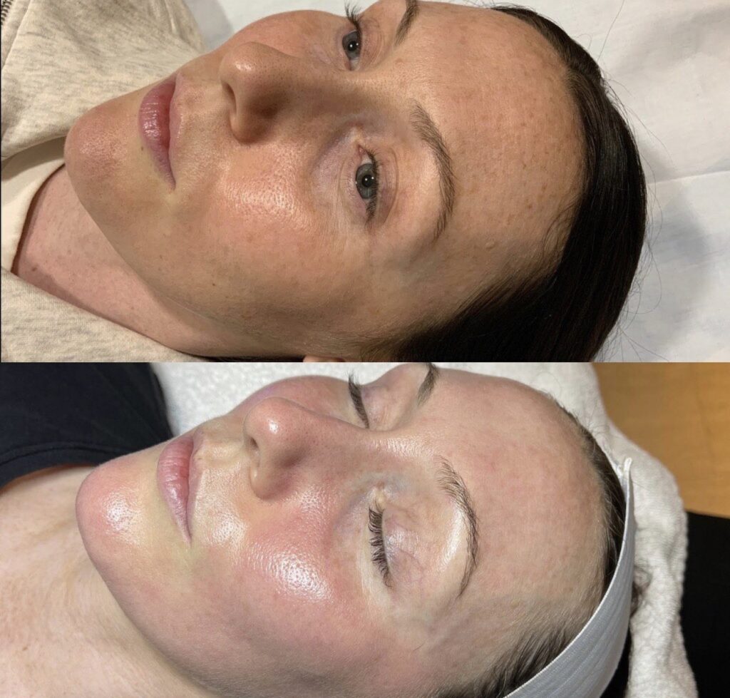 Before and After Image: BBL + Moxi - other