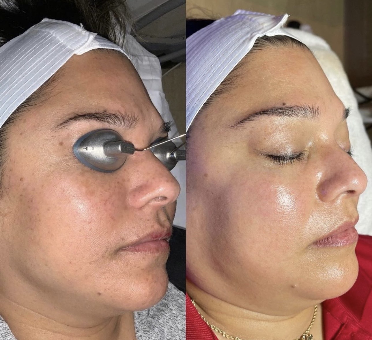 Before and After Image: BBL Series + One Hydrafacial - right-front-oblique
