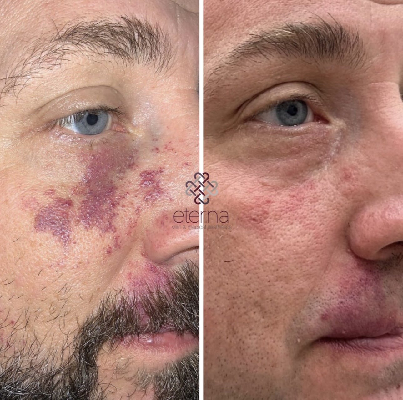 Before and After Image: Birthmark treated with Excel V+ - right-front-oblique