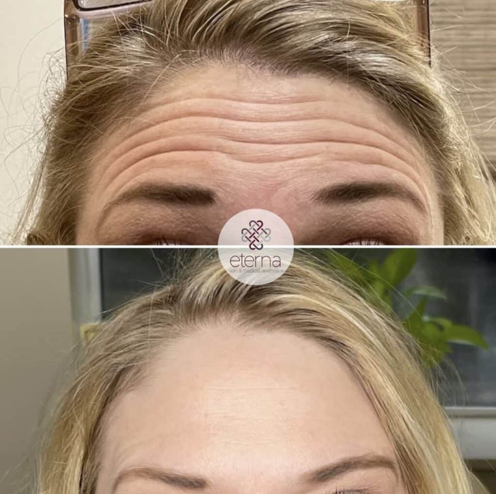 Before and After Image: Botox - front