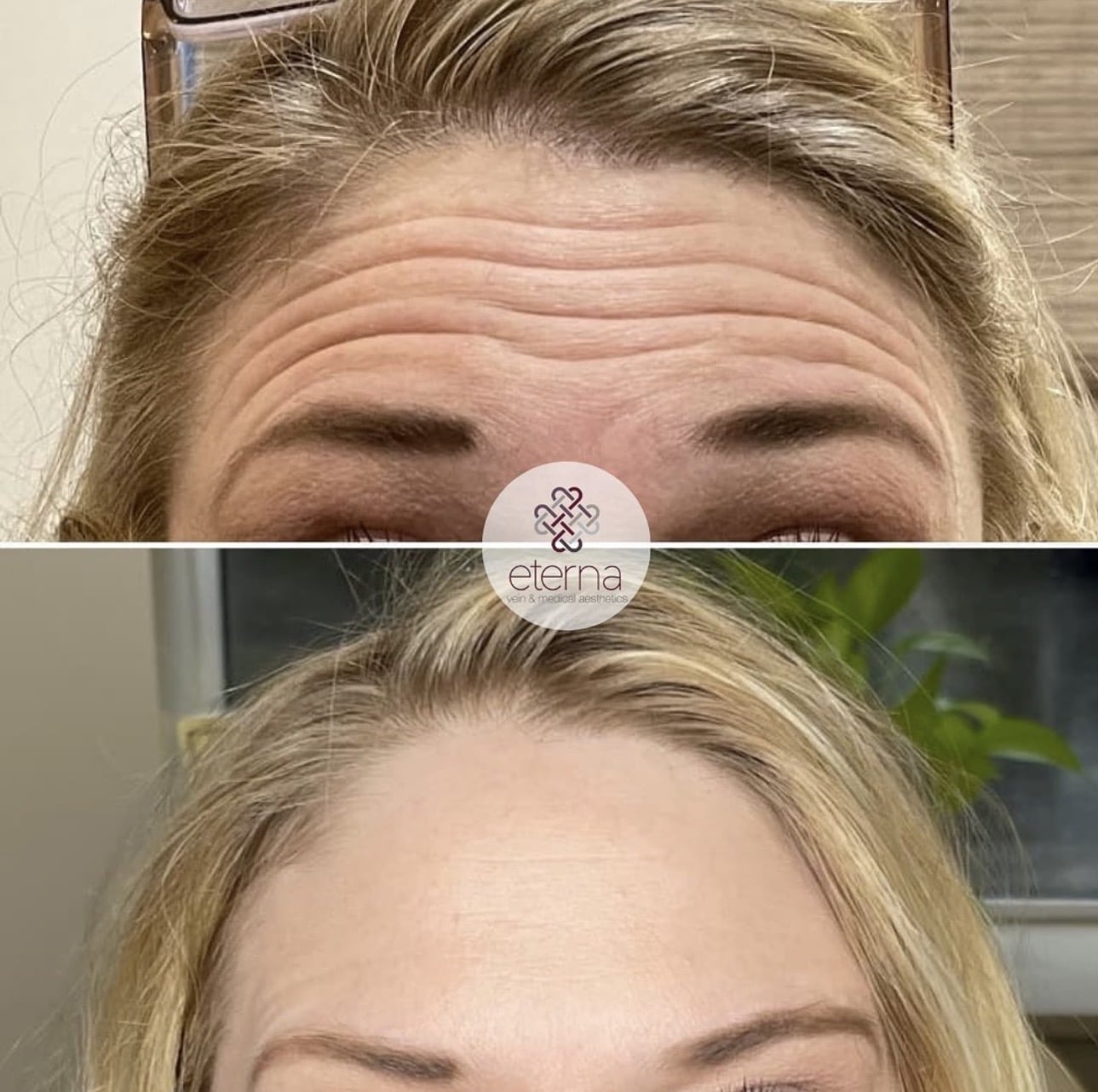 Before and After Image: Botox - front