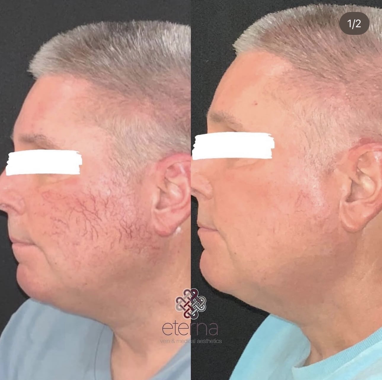 Before and After Image: Excel V+ Laser for Spider Veins - left-side