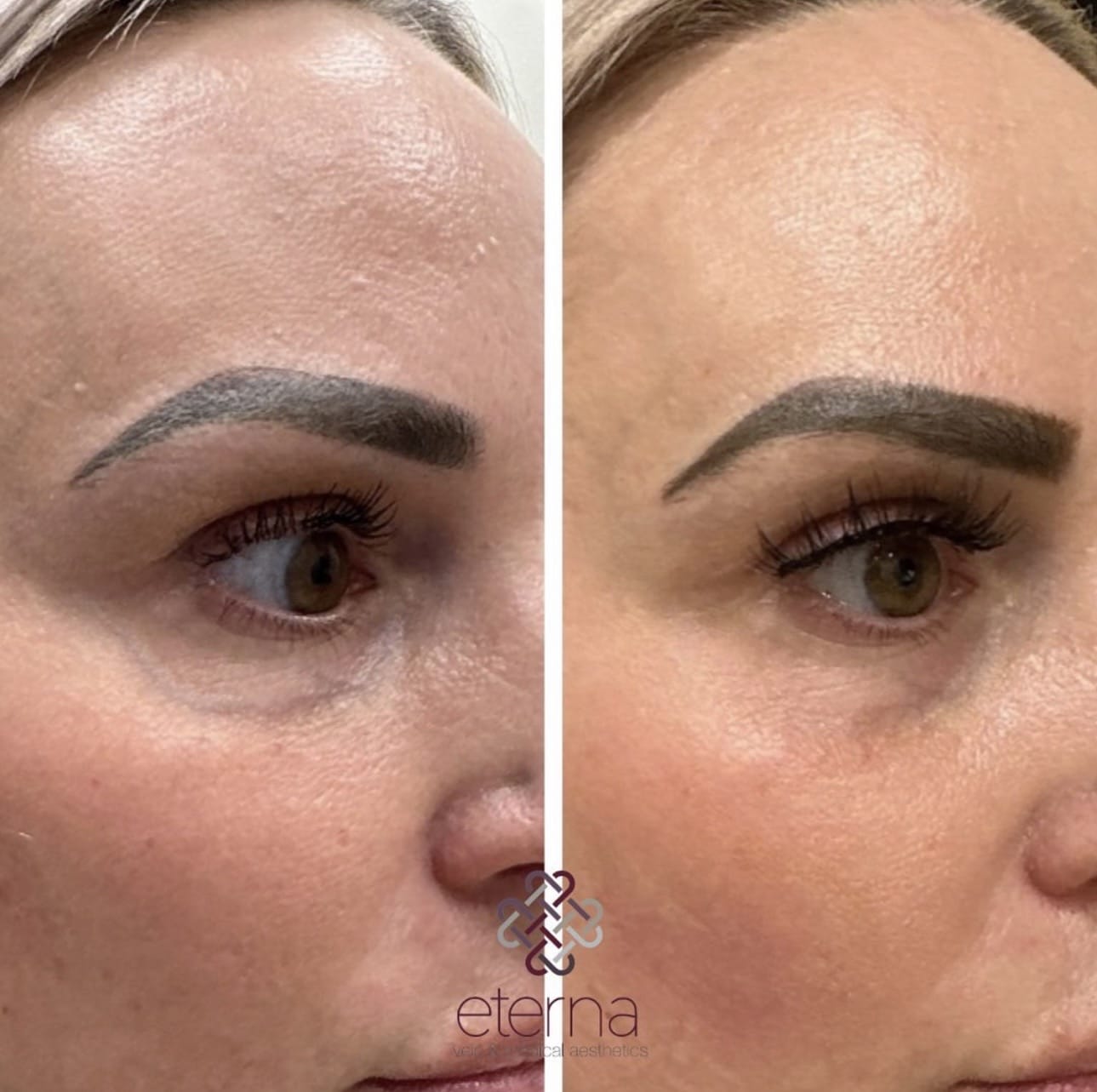 Before and After Image: Excel V+ for Undereye Veins - right-front-oblique