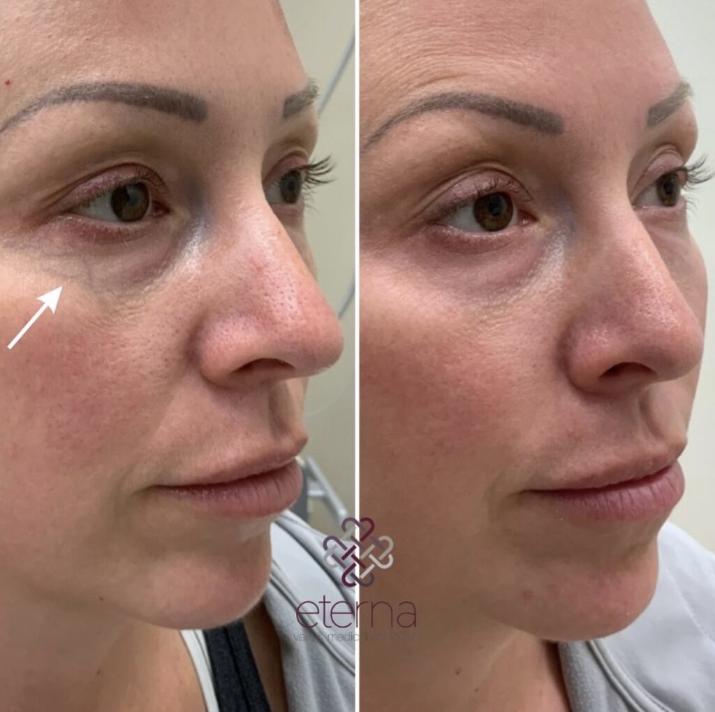 Before and After Image: Excel V+ for Undereye Veins - right-front-oblique