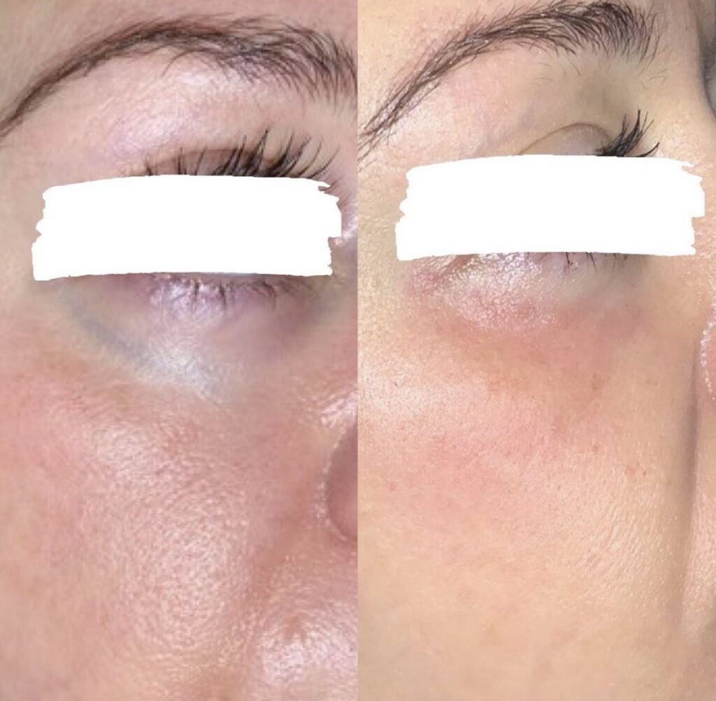Before and After Image: Excel V+ for Undereye Veins - right-front-oblique