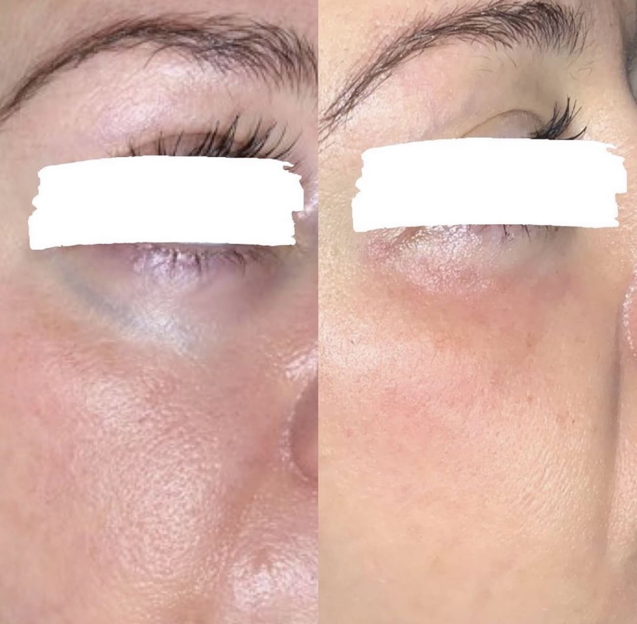 Before and After Image: Excel V+ for Undereye Veins - right-front-oblique