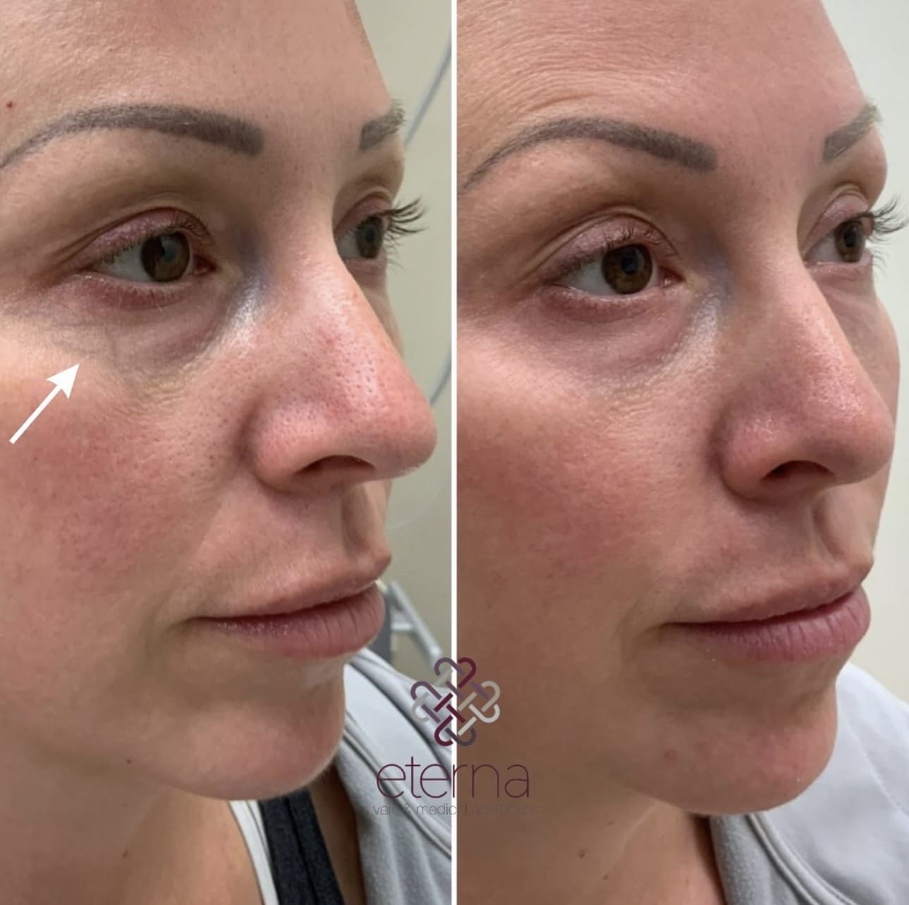 Before and After Image: Excel V+ for Undereye Veins - right-front-oblique