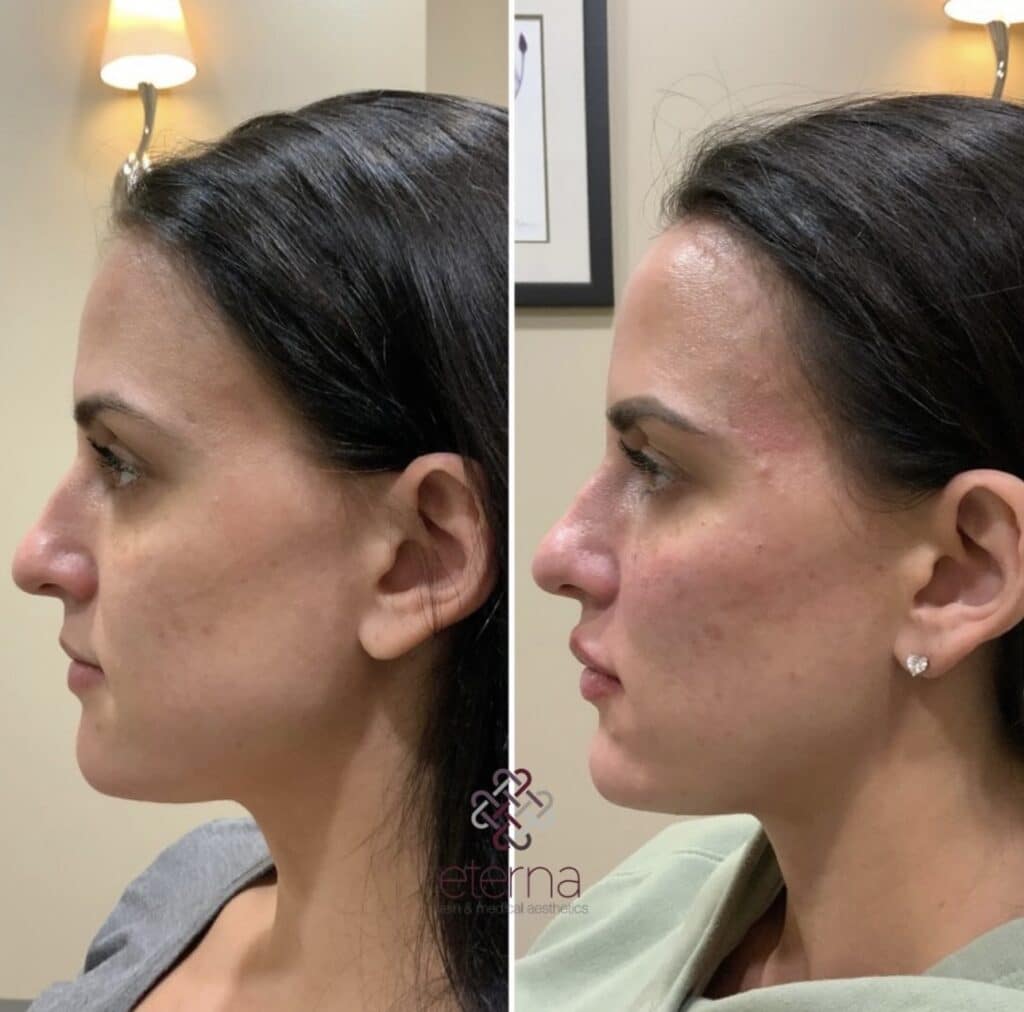 Before and After Image: Facial Balancing with Filler - left-side