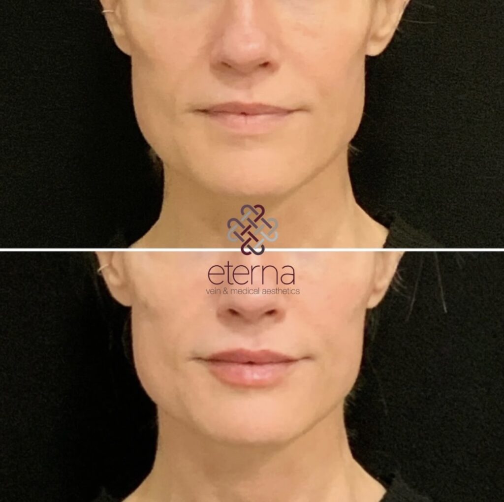 Before and After Image: Facial Balancing with Filler - front