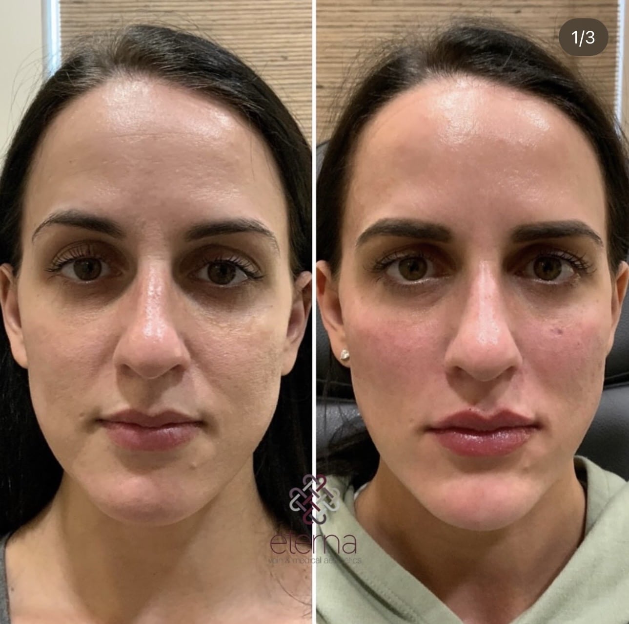 Before and After Image: Facial Balancing with Filler - front