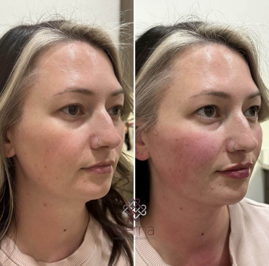 Before and After Image: Facial Balancing with Filler - right-front-oblique