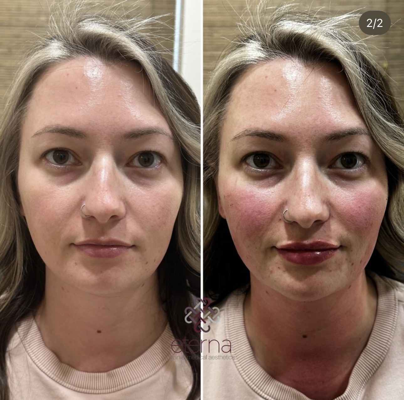 Before and After Image: Facial Balancing with Filler - front