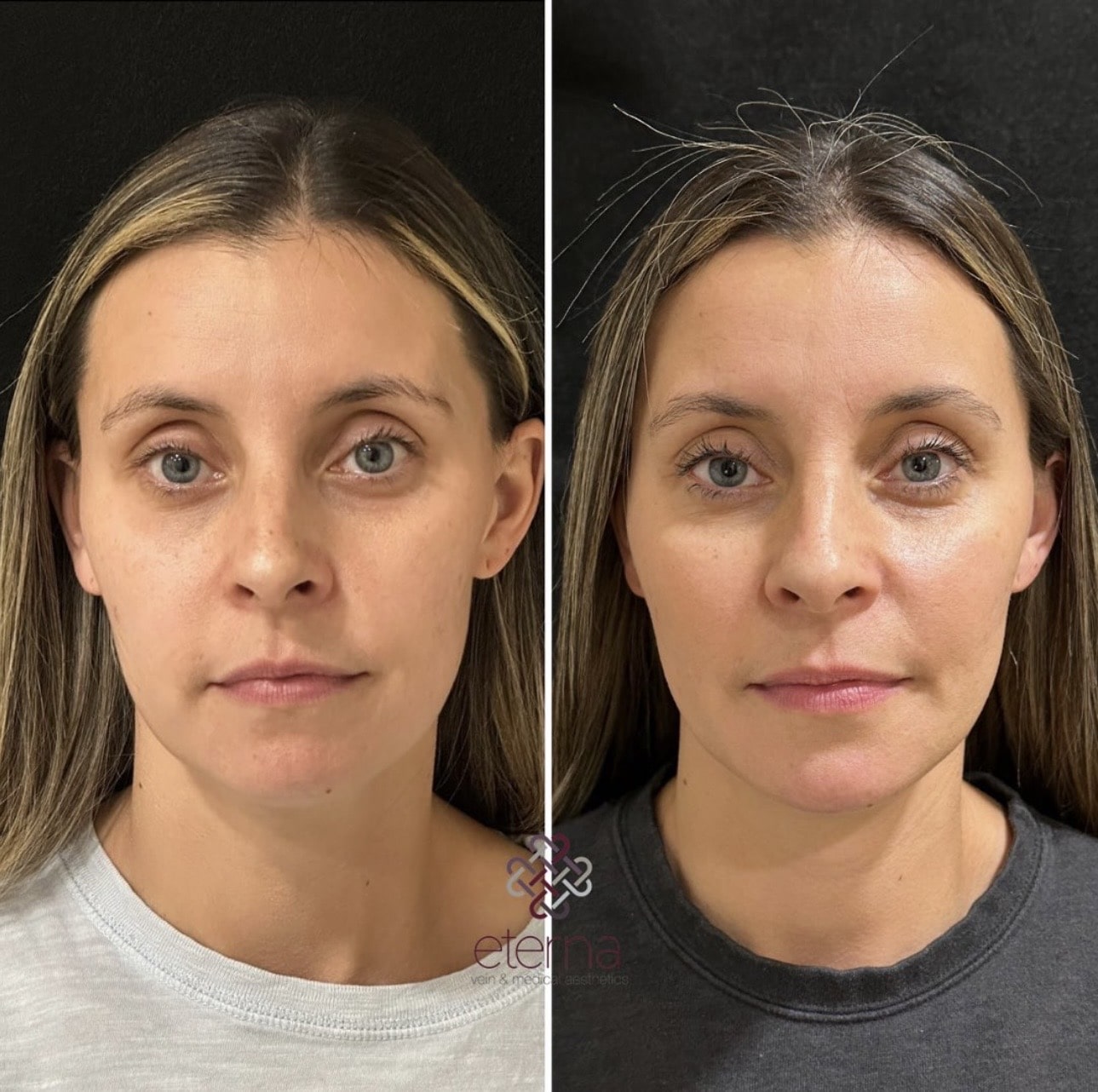 Before and After Image: Facial Balancing with Filler - front