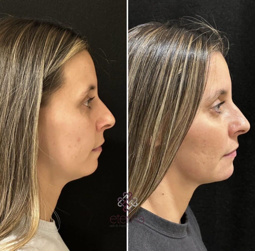 Before and After Image: Facial Balancing with Filler - right-side