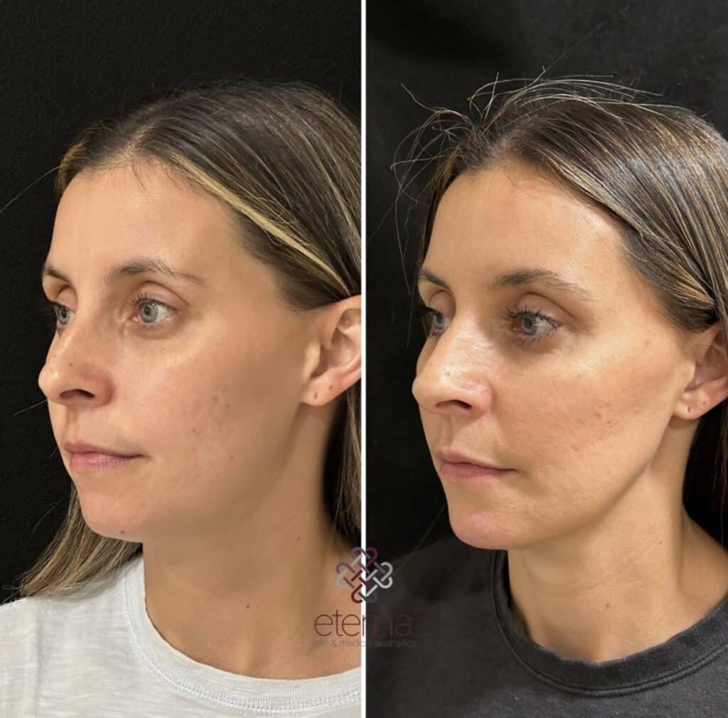 Before and After Image: Facial Balancing with Filler - left-front-oblique
