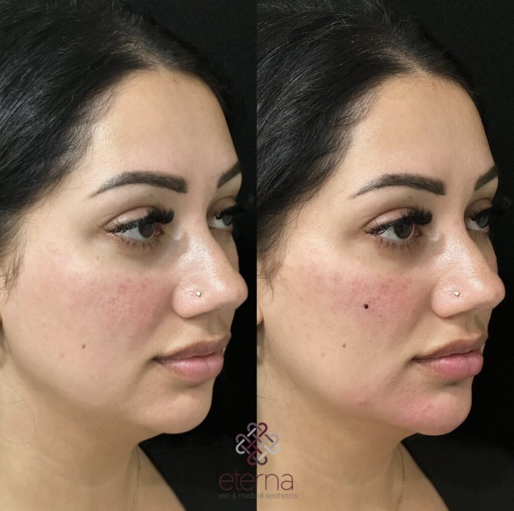 Before and After Image: Facial Balancing with Filler - right-front-oblique