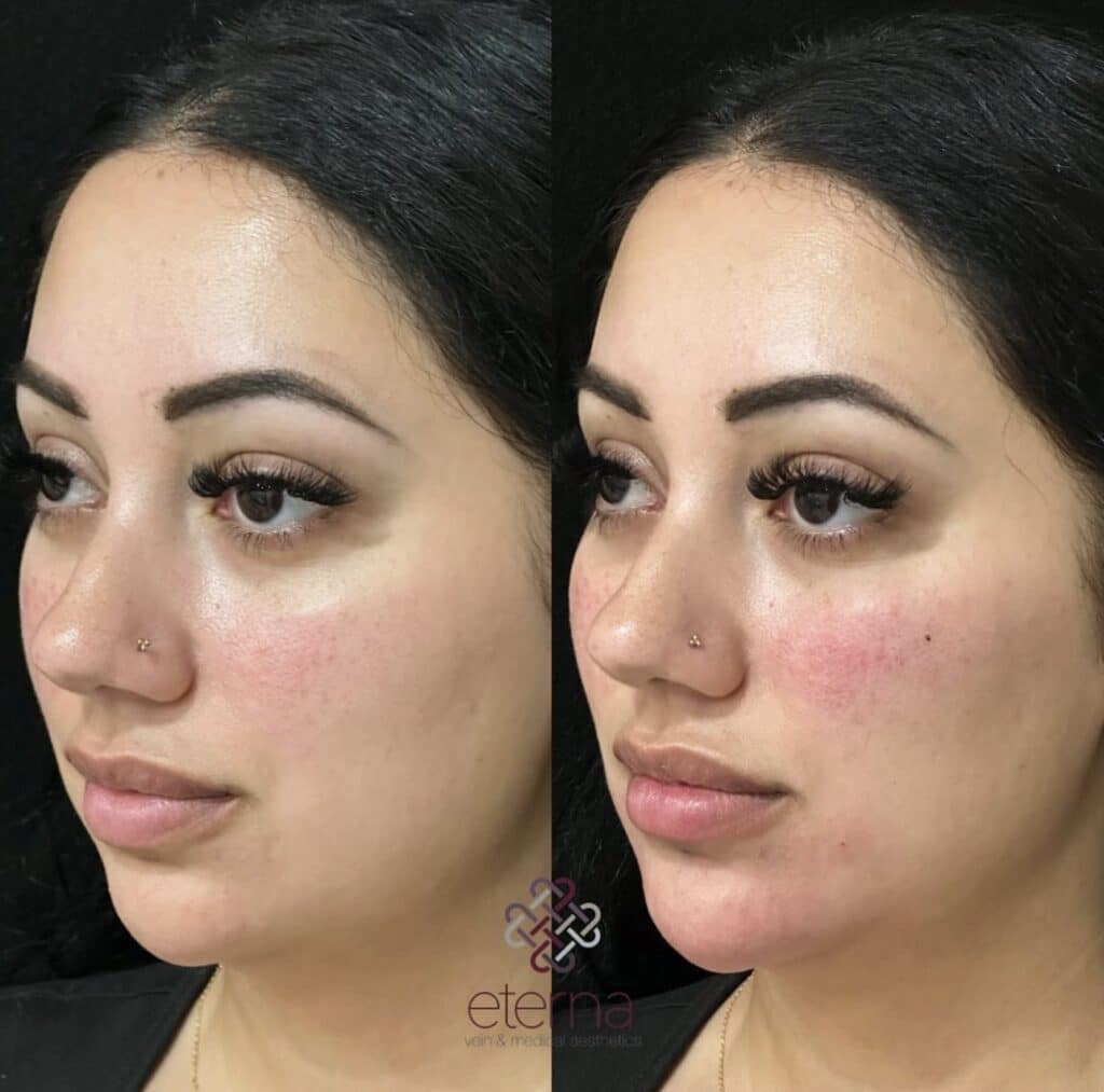 Before and After Image: Facial Balancing with Filler - left-front-oblique