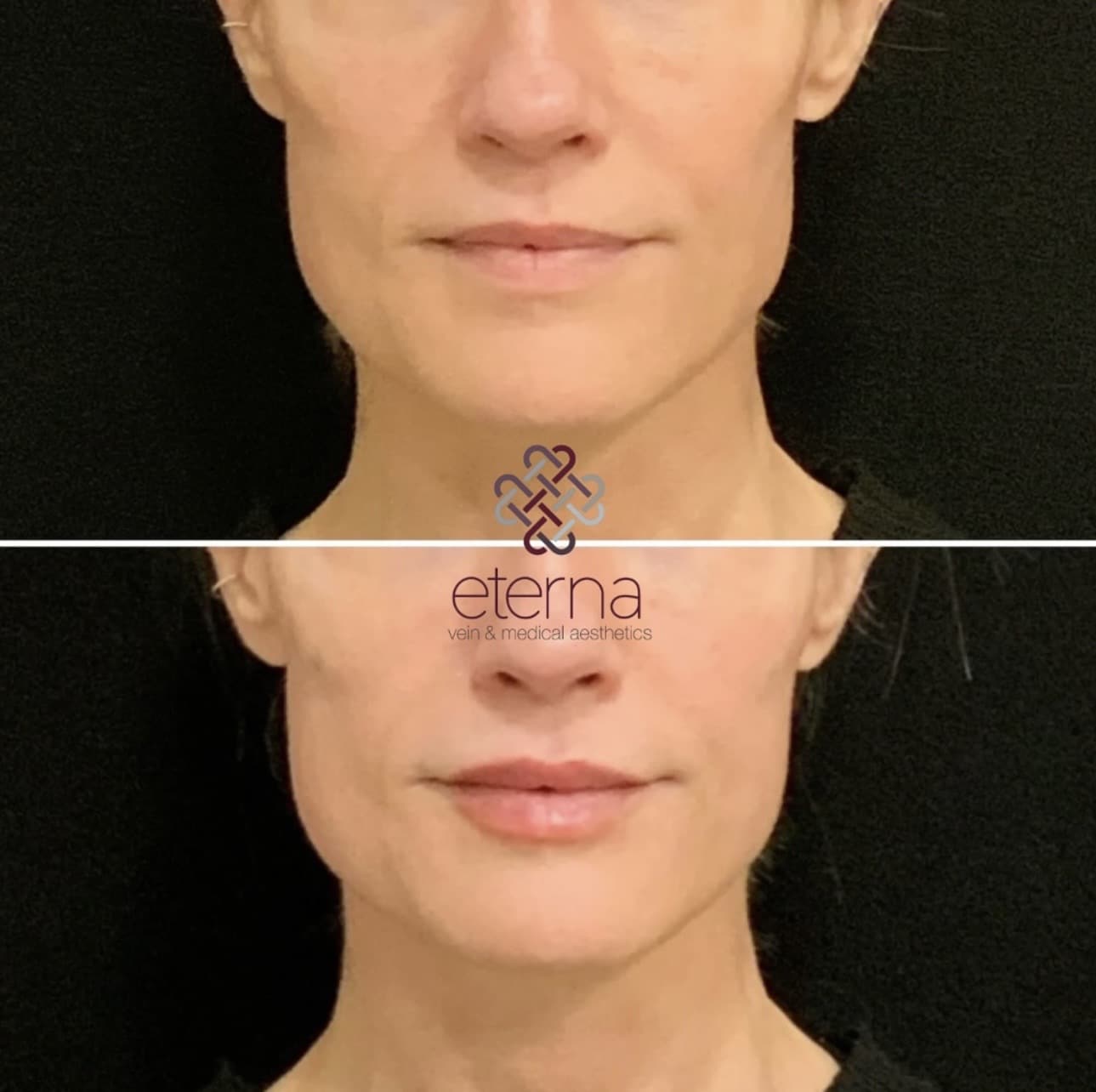 Before and After Image: Facial Balancing with Filler - front