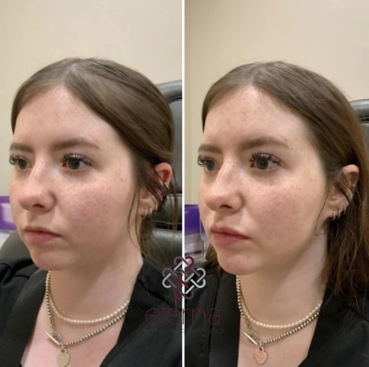 Before and After Image: Lip + Chin Filler - left-front-oblique