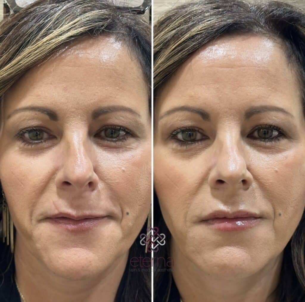 Before and After Image: Lip Filler - front