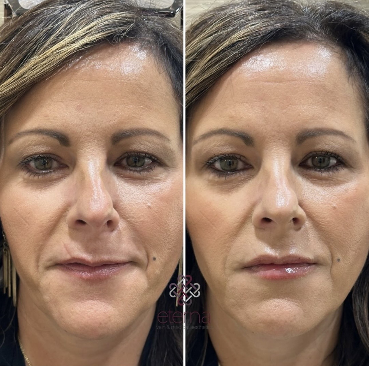 Before and After Image: Lip Filler - front
