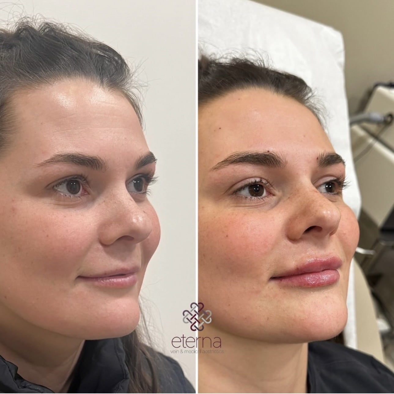 Before and After Image: Lip Filler - right-front-oblique