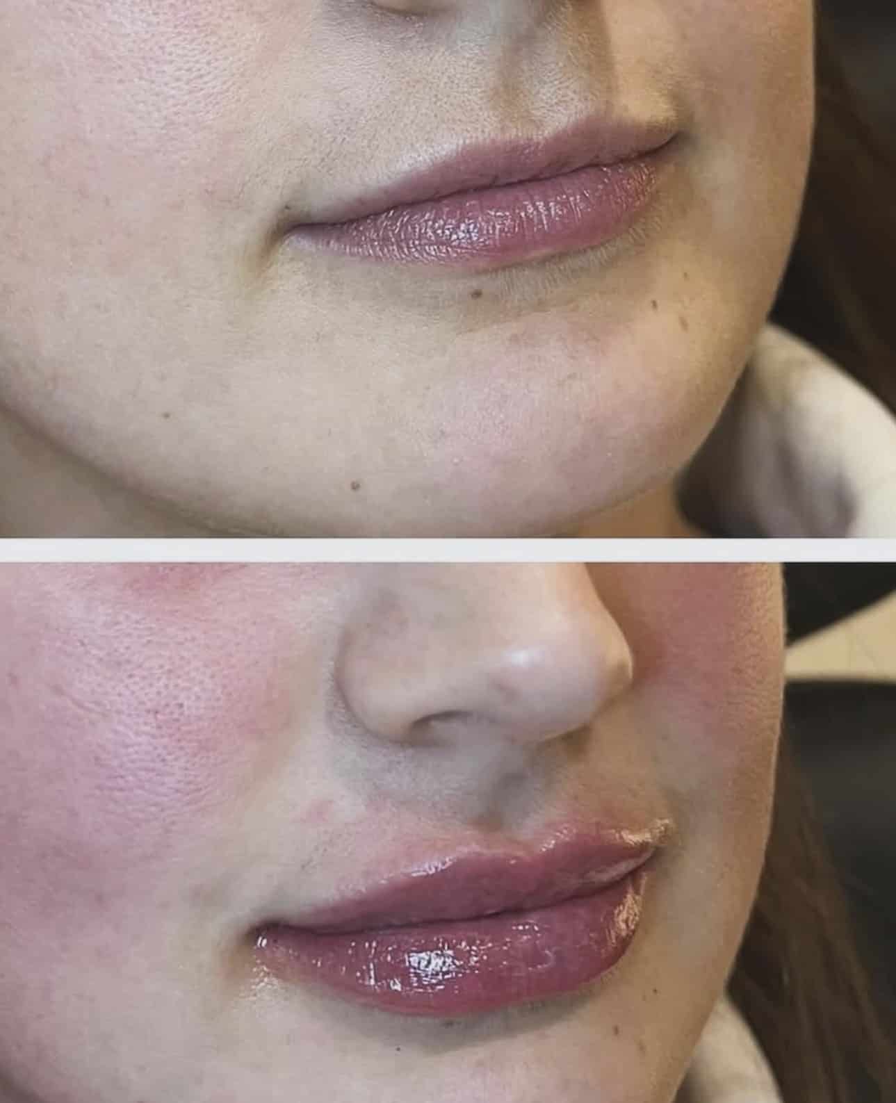 Before and After Image: Lip Filler - right-front-oblique