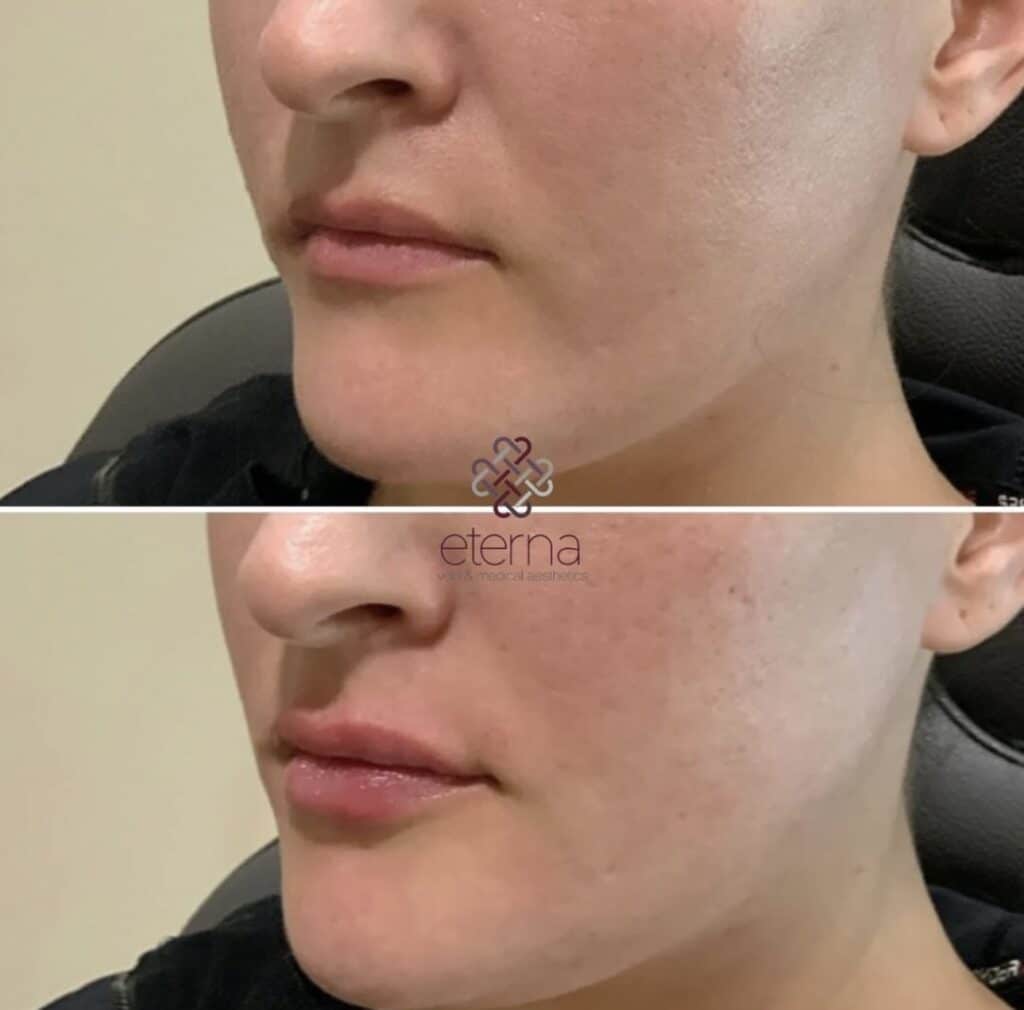 Before and After Image: Lip Filler - left-front-oblique