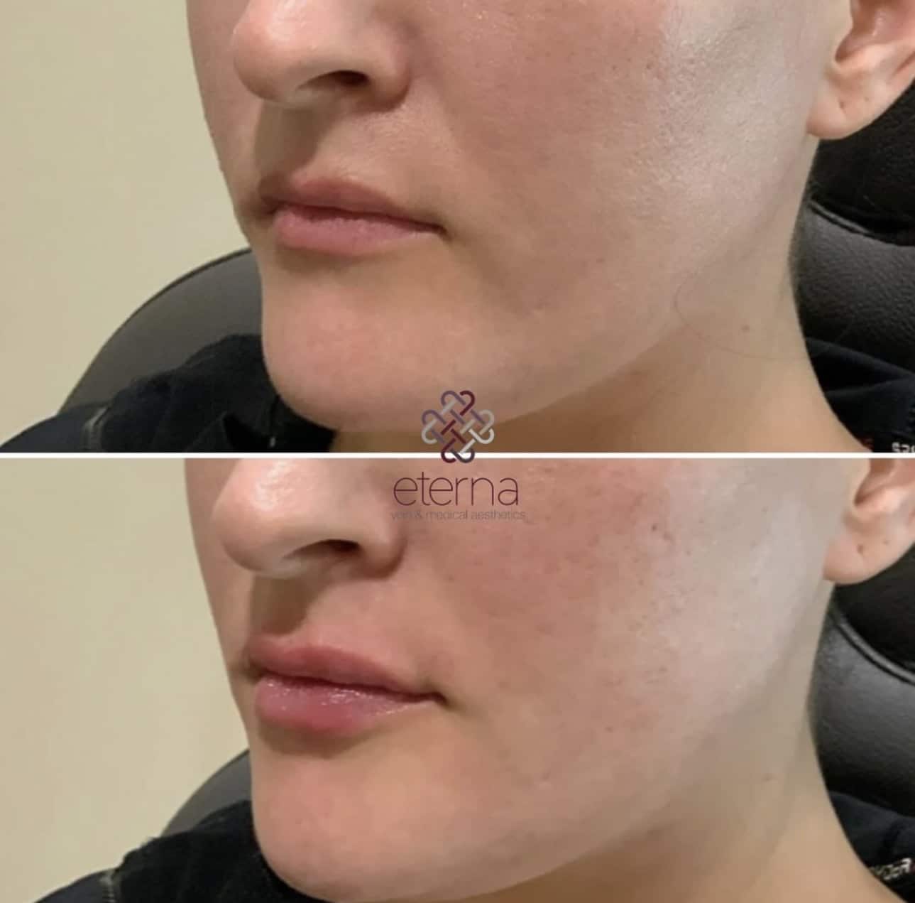 Before and After Image: Lip Filler - left-front-oblique