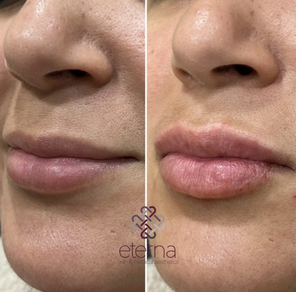 Before and After Image: Lip Filler - left-front-oblique