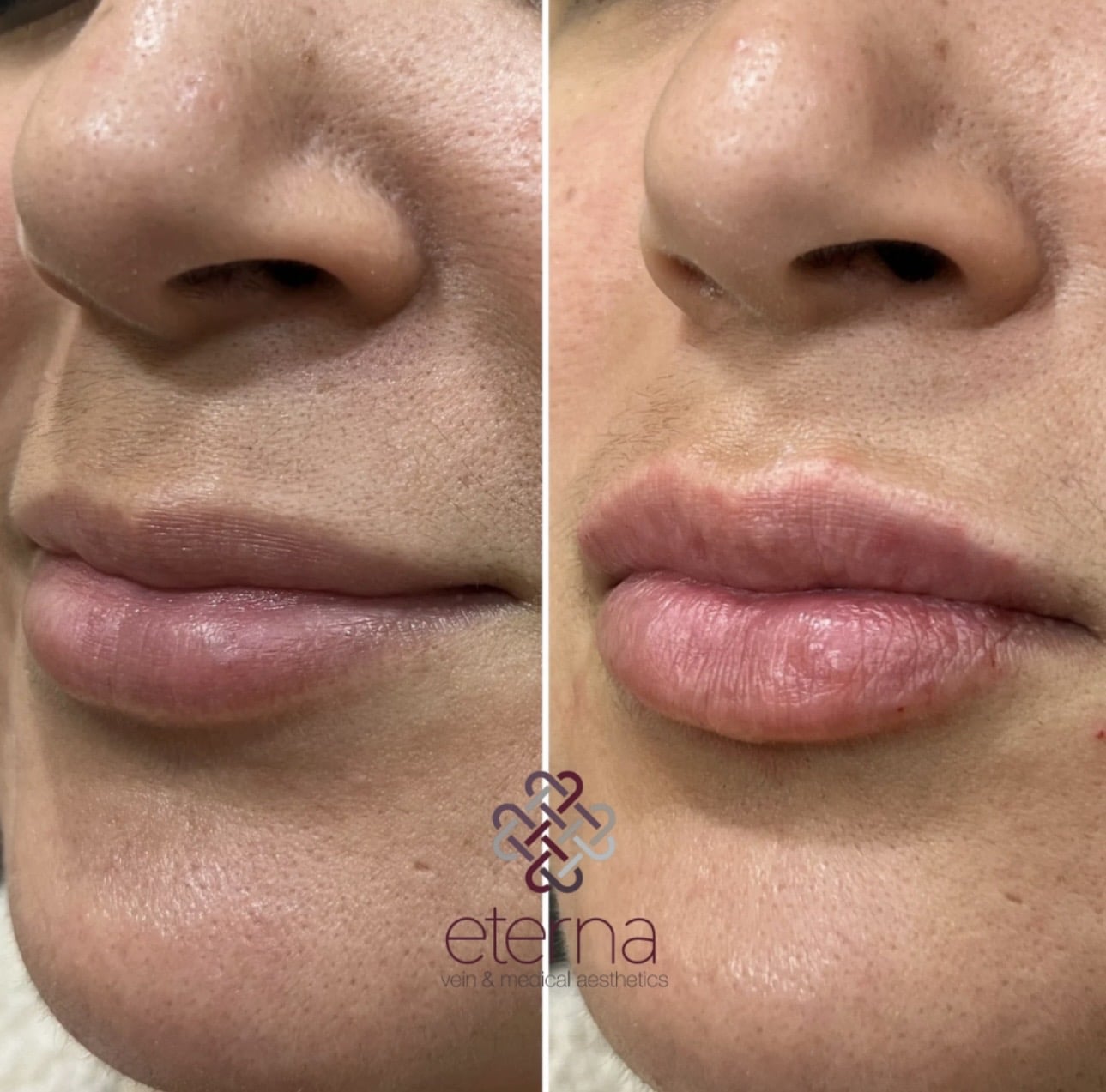 Before and After Image: Lip Filler - left-front-oblique