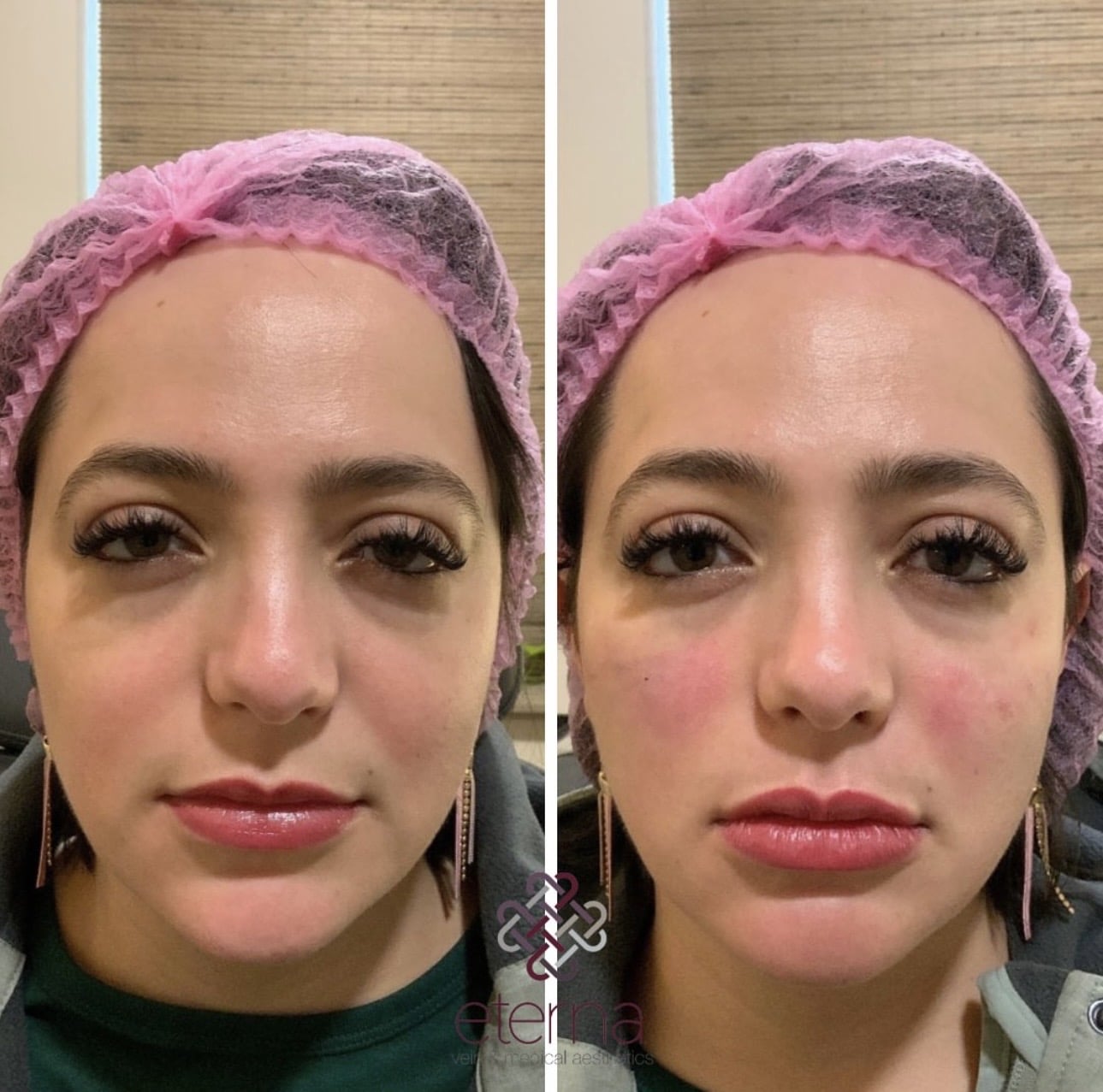 Before and After Image: Lips and Cheek Filler - front
