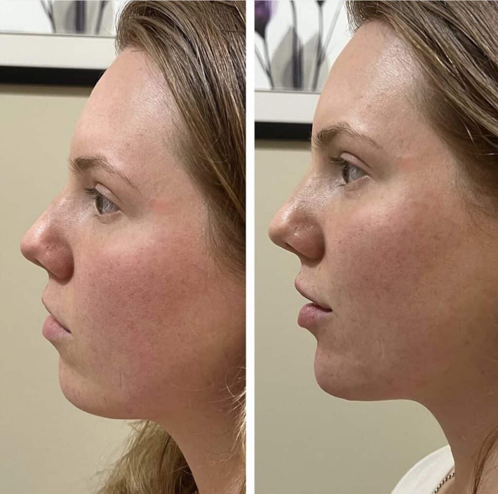 Before and After Image: Lips and Chin Filler - left-side