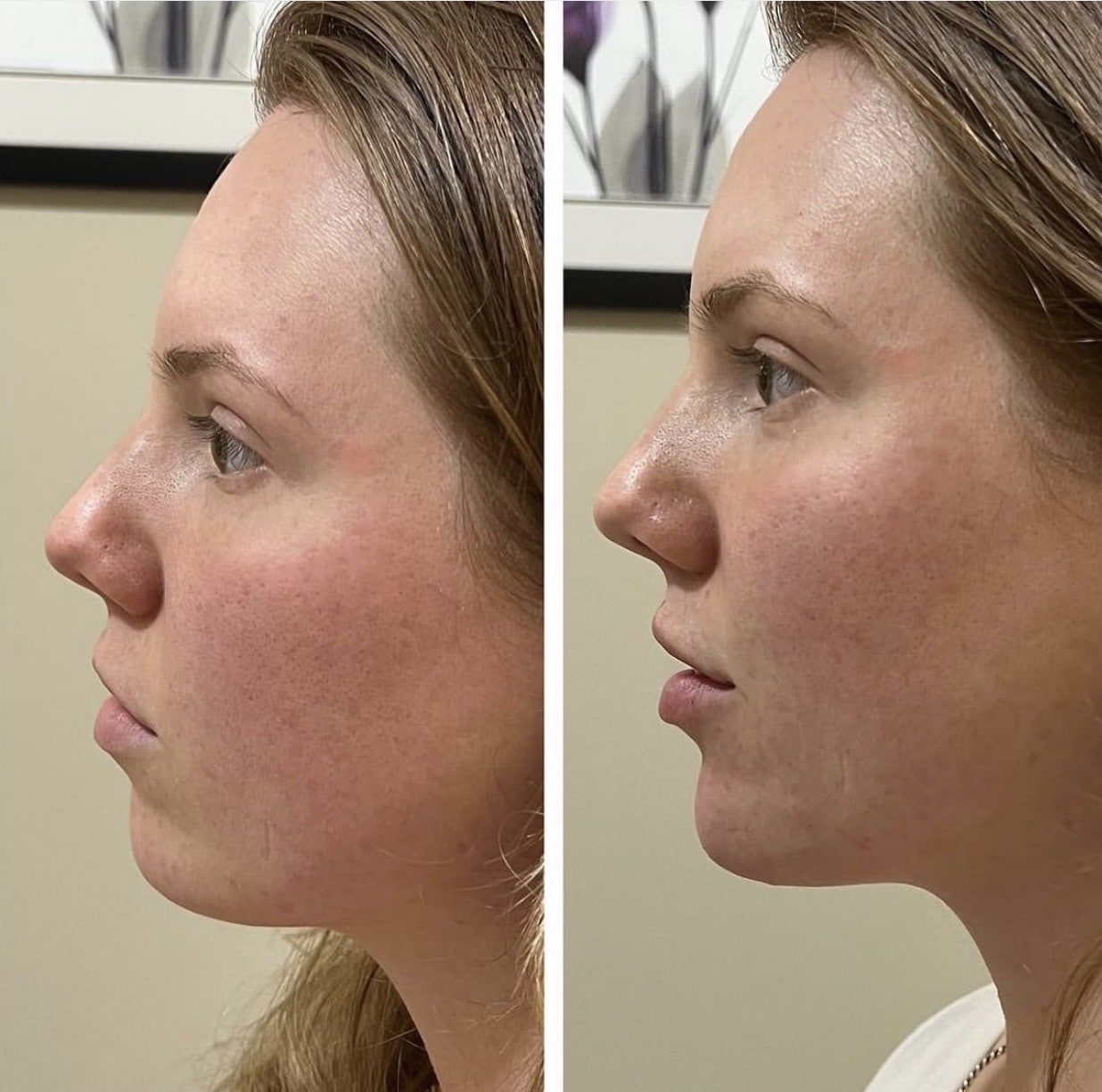 Before and After Image: Lips and Chin Filler - left-side
