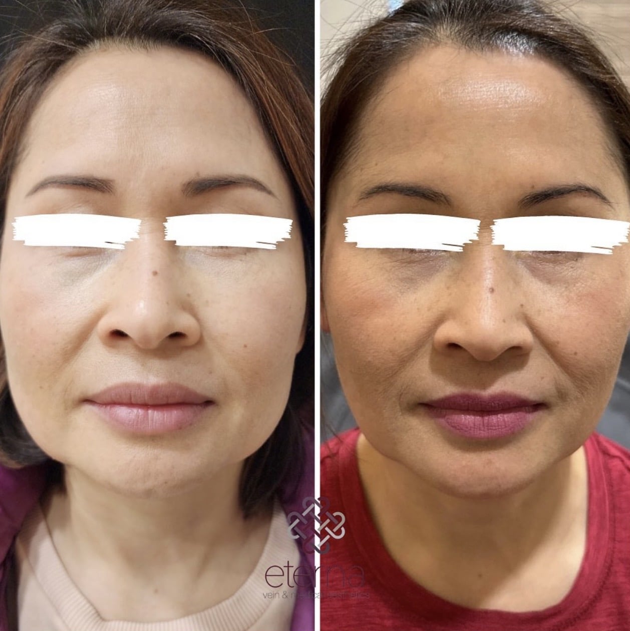 Before and After Image: Masseter Botox - front