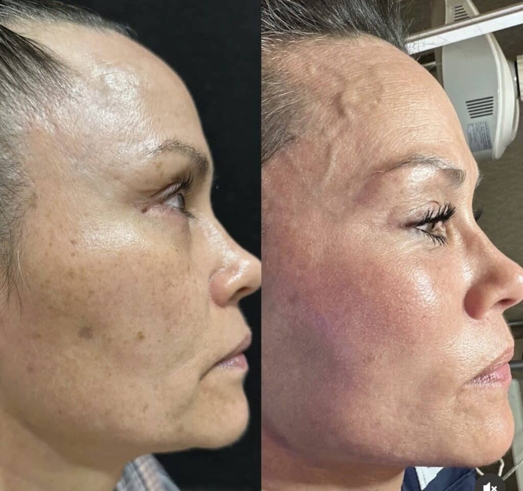 Before and After Image: Moxi - right-side