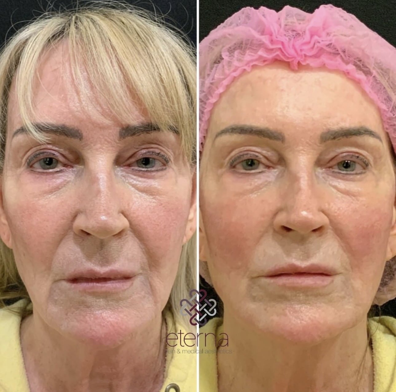 Before and After Image: PDO Threads - front