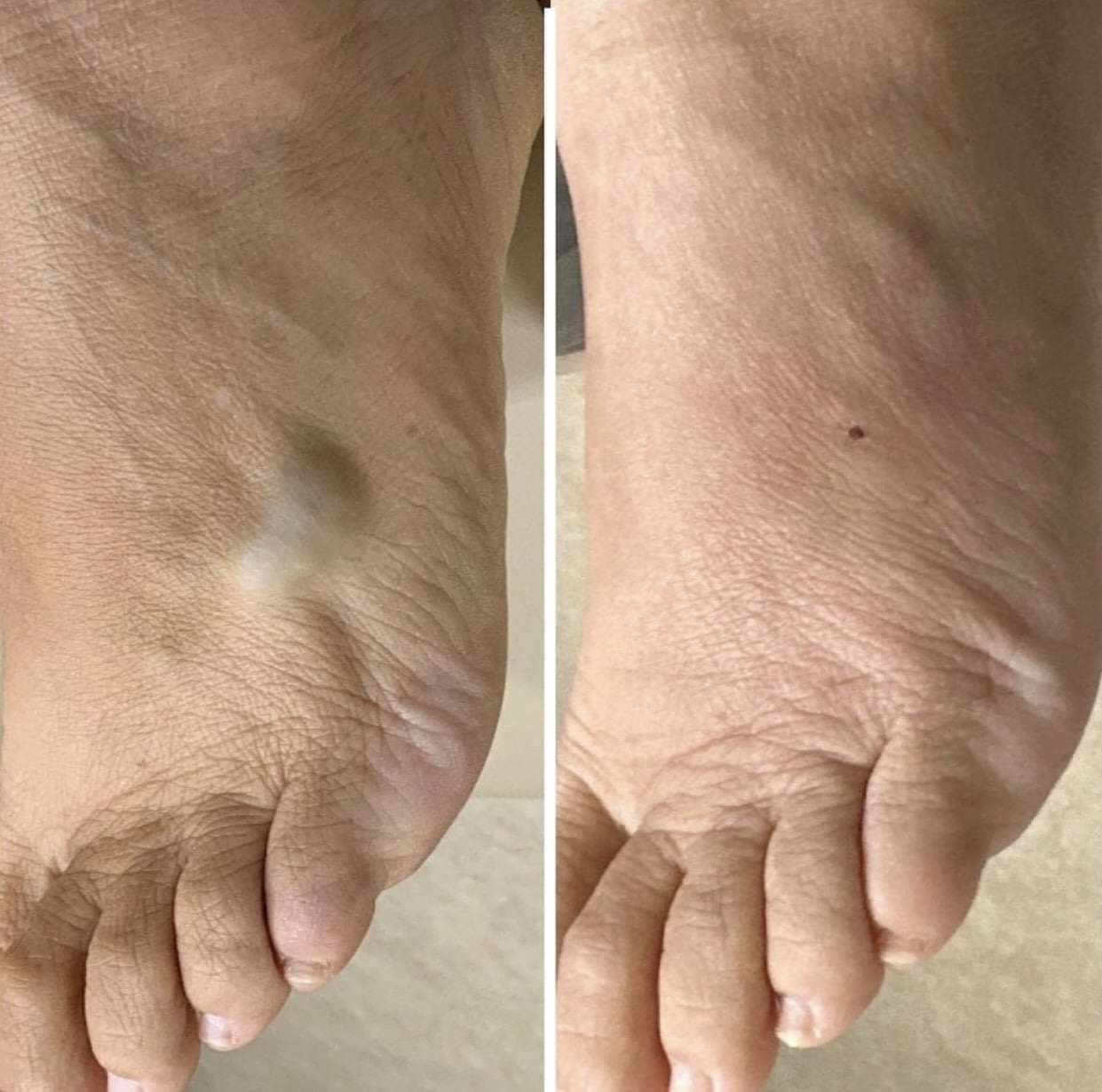 Before and After Image: Phlebectomy - right-side