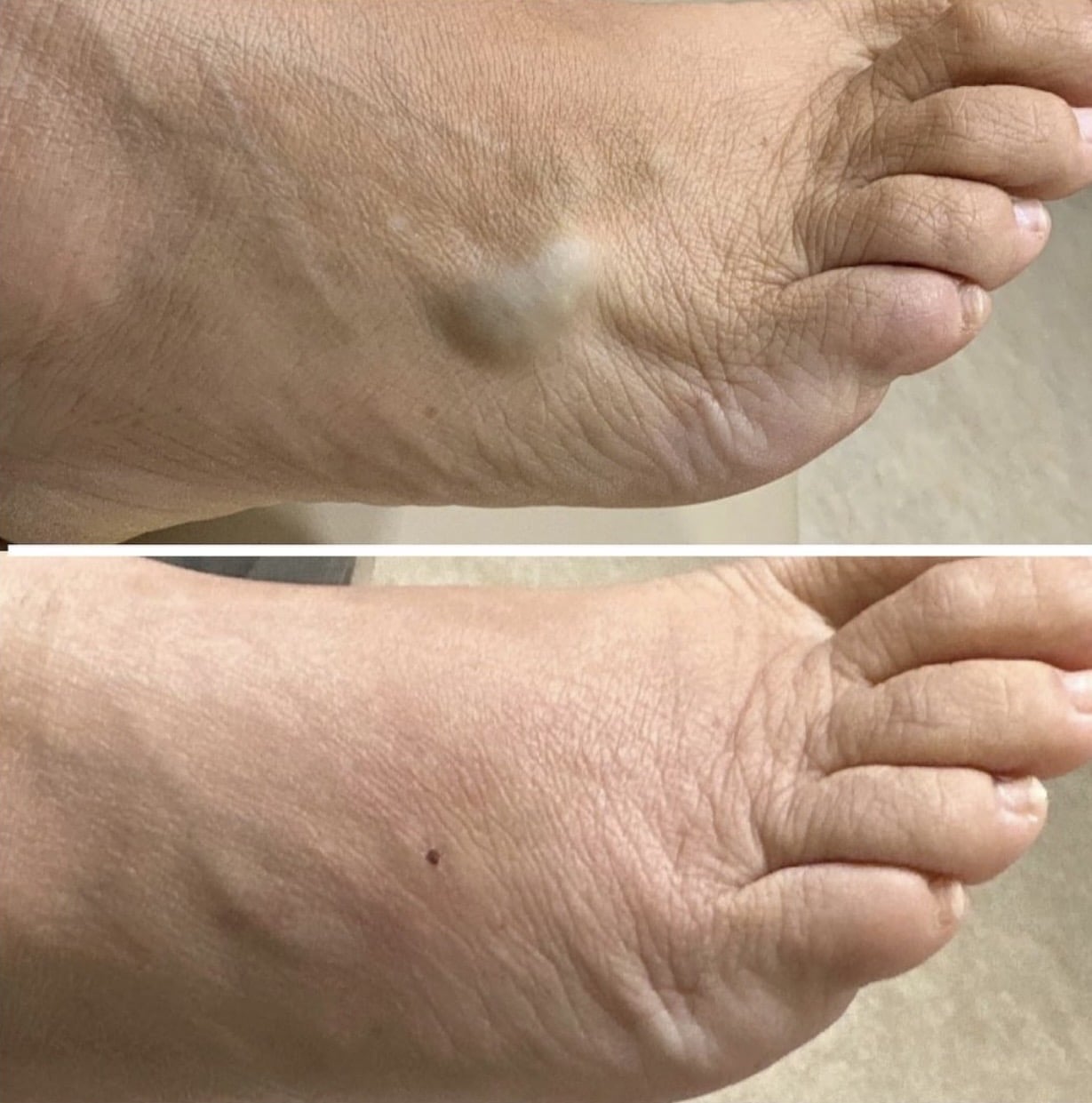 Before and After Image: Phlebectomy - right-side